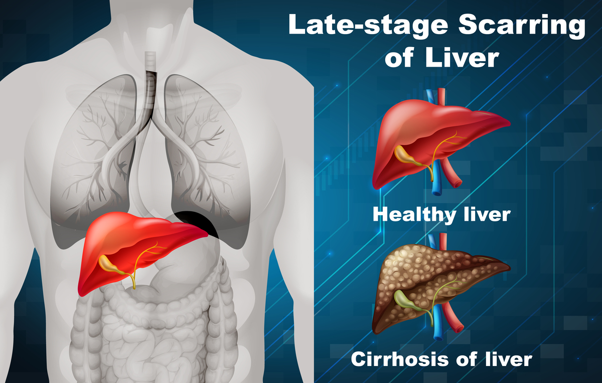 Late-stage scarring of liver illustration