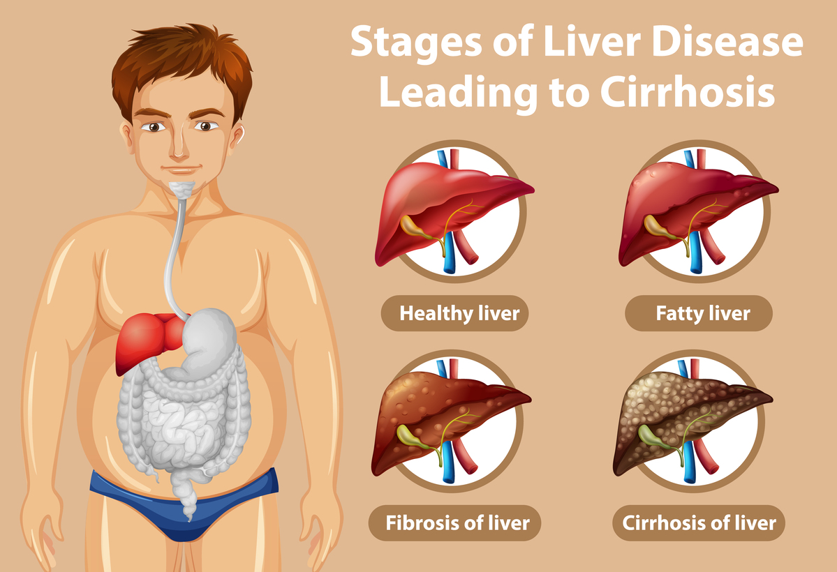 Stages of liver disease leading to Cirrhosis illustration