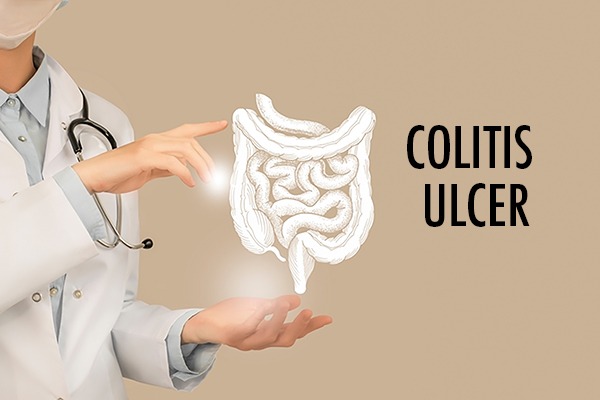 Colitis Ulcer treatment