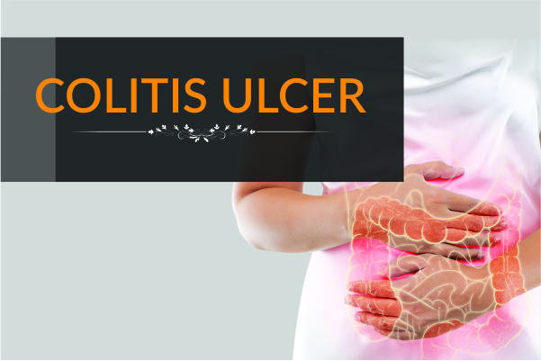 Colitis Ulcer